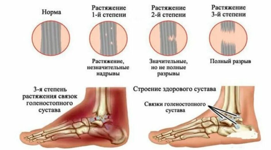 Растяжение связки голеностопа фото симптомы Что происходит при растяжении связок