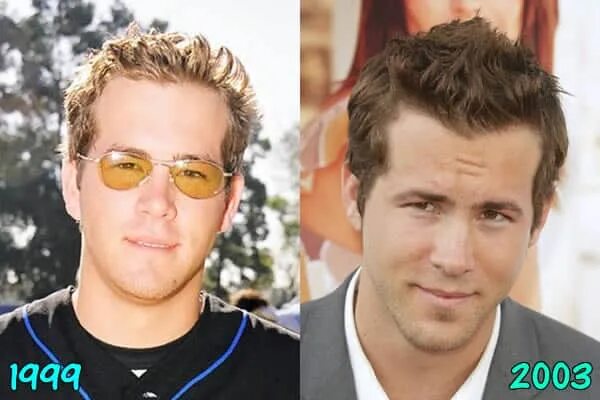 Райан рейнольдс фото до и после пластики Ryan Reynolds Plastic Surgery - Hair Transplant, Teeth Fix, Nose Job?