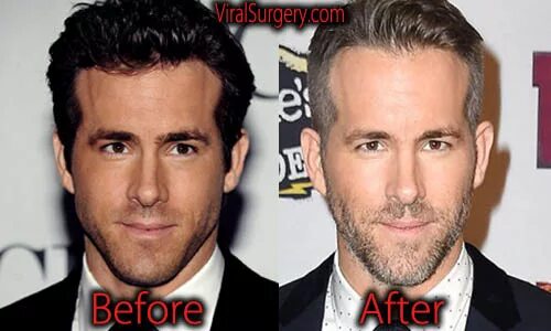 Райан рейнольдс фото до и после пластики Ryan Reynolds Plastic Surgery: Before and After Botox Pictures