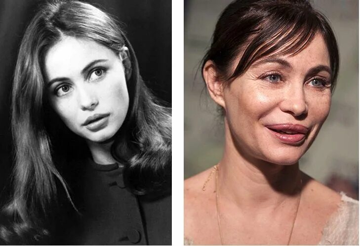 Разбегаев до и после пластики фото Emmanuelle Beart Celebrity Plastic Surgery in 2019 Celebrity surgery, Celebrity 