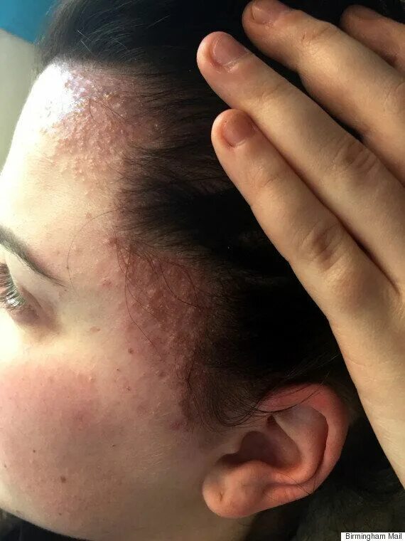 Раздражительный дерматит на шее фото Sisters Left With Swollen, Scab-Covered Heads After Allergic Reaction To Salon H