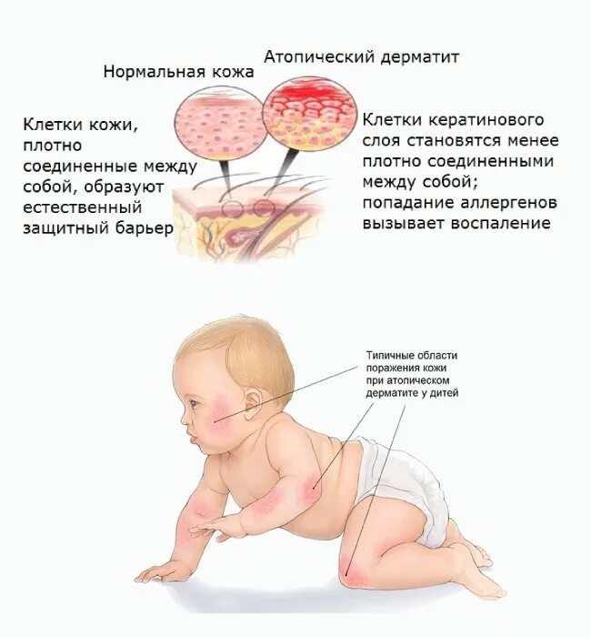 Раздражительный дерматит у ребенка как выглядит фото Атопический дерматит у детей: красные щеки, корки на лице и теле, проблемы с едо