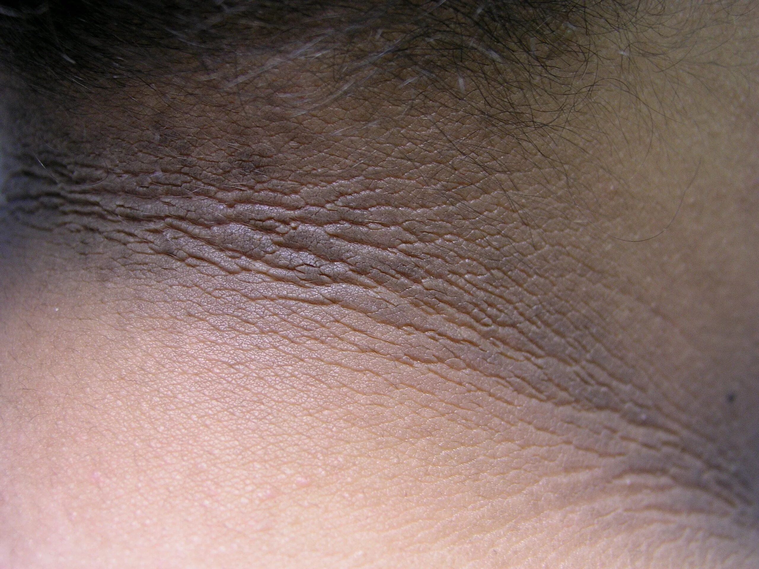 Раздражительный дерматит в паху у женщин фото Acanthosis nigricans - Cancer Therapy Advisor