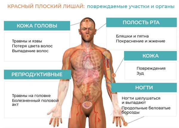 Разновидности лишаев у человека фото и описание Farmf литература для фармацевтов : Лекции " Красный плоский лишай. Классификация