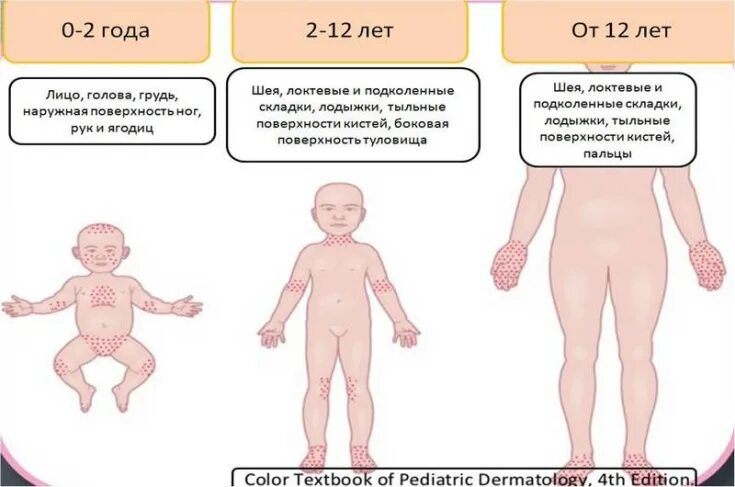 Разновидности сыпи у детей фото с названиями Изменения иммунитета при атопическом дерматите - Estet-Portal