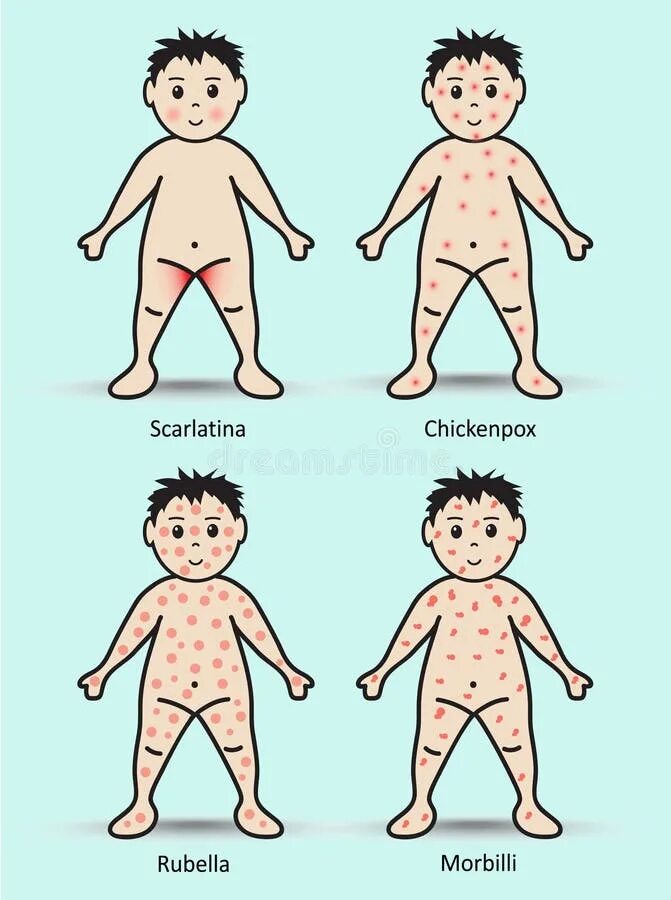 Разновидности сыпи у детей фото с названиями Baby rash, skin rash stock vector. Illustration of human - 67052067