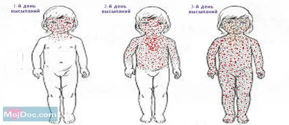 Разновидности сыпи у детей фото с названиями Может ли ветрянка у детей протекать без температуры и при небольшом количестве в