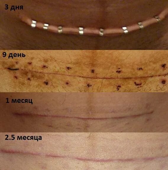 Разошлись швы как выглядит зуб Чем и как долго обрабатывать шов после кесарева сечения