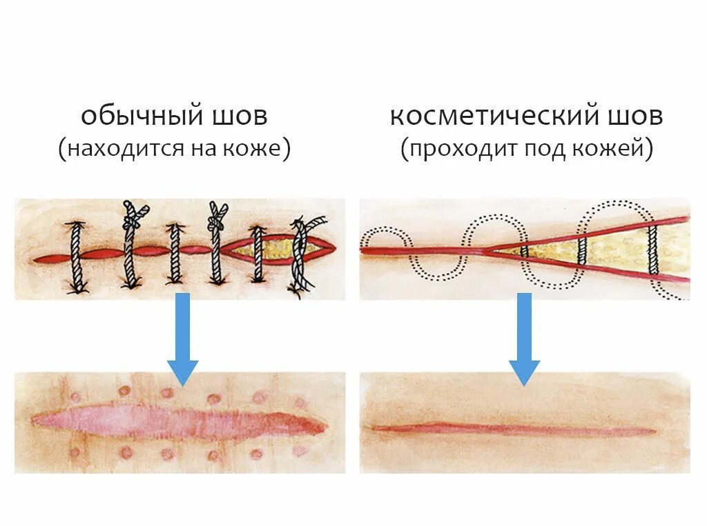 Разошлись швы как выглядит зуб Пластический шов