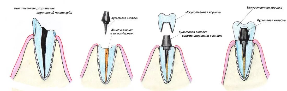 Разошлись швы как выглядит зуб Культевые штифты