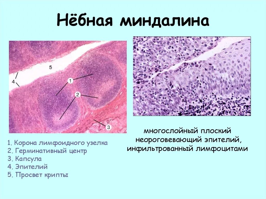 Разрастание лимфоидной ткани миндалины фото Эпителий миндалин