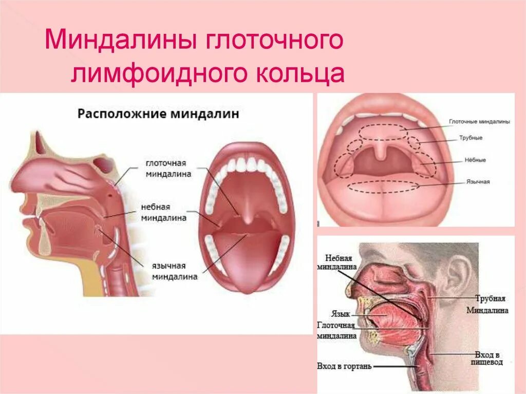 Разрастание лимфоидной ткани миндалины фото Увеличение глоточной миндалины