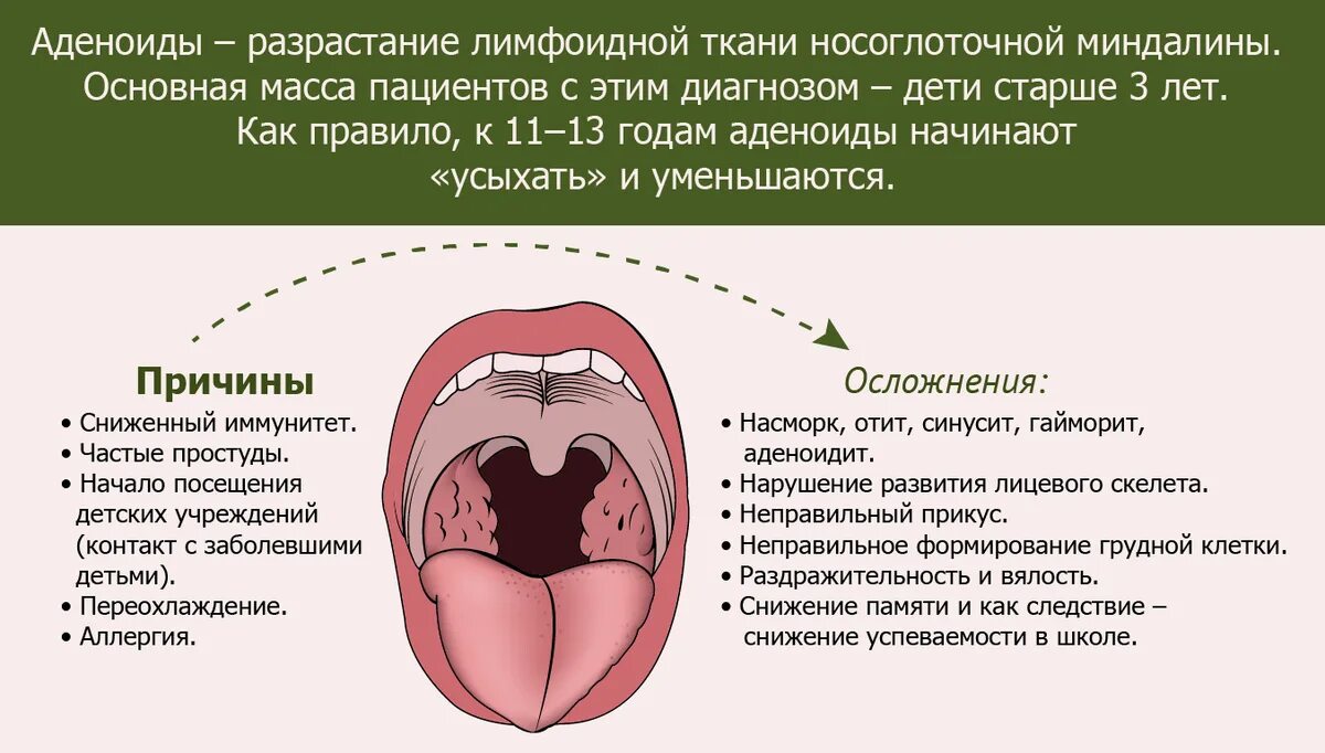 Разрастание лимфоидной ткани миндалины фото Увеличение глоточной миндалины