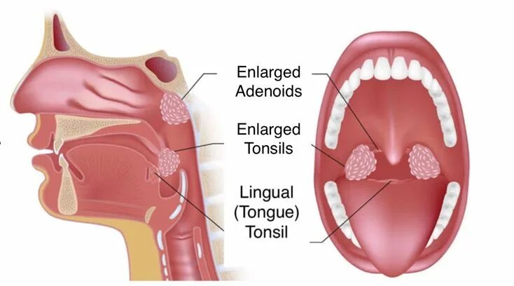 Разрастание лимфоидной ткани в горле фото Tonsils and adenoids, Tonsil stones, Chronic sinusitis