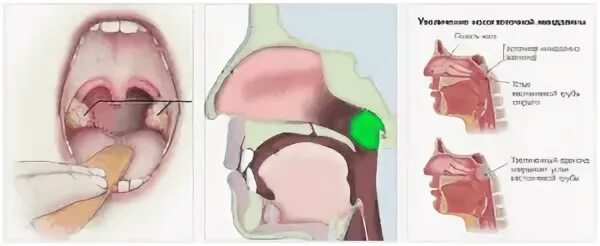 Разрастание лимфоидной ткани в горле фото Как лечить сопли у ребенка, если жидкость стекает из носа в горло по задней стен