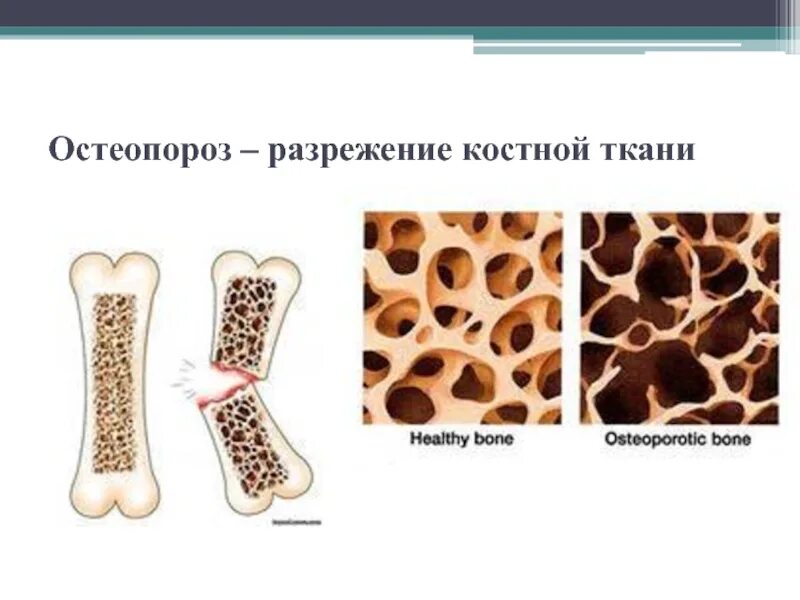 Разрежение ткани фото Недостаточно костной ткани