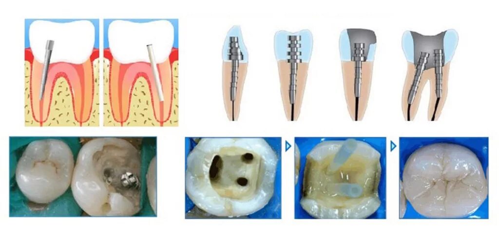 Разрушение зуба более 50 процентов как выглядит Штифт в зубе - цена, виды, установка НоваДент