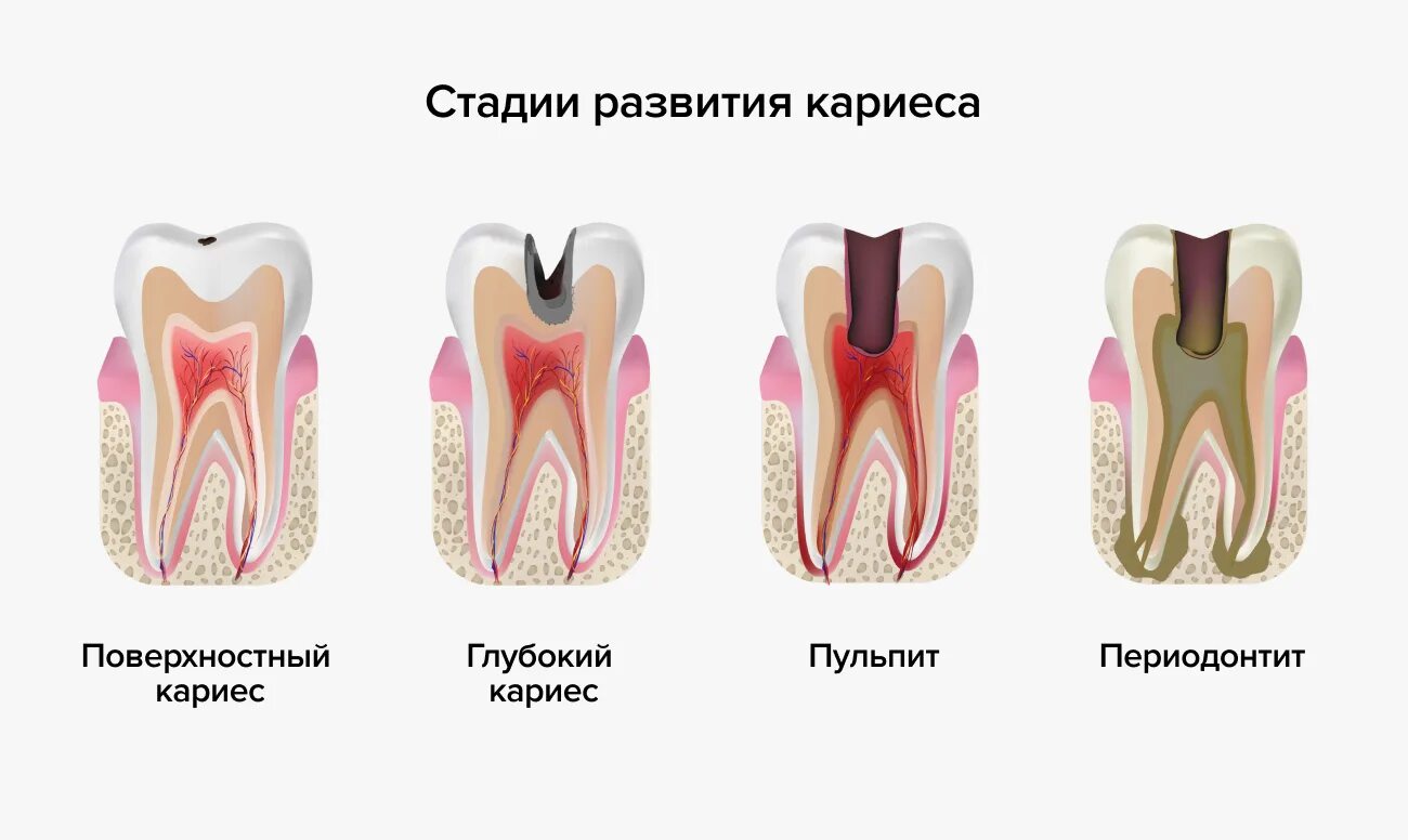 Разрушение зуба более 50 процентов как выглядит Начальная стадия кариеса зубов