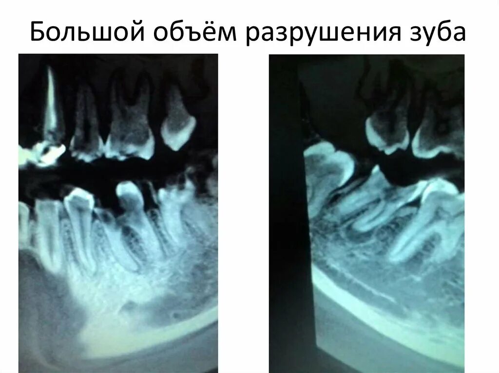 Разрушение зуба более 50 процентов как выглядит Удаление зубов - презентация онлайн