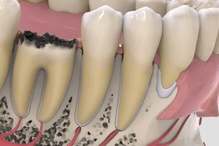Разрушение зуба более 50 процентов как выглядит Раздел блога "Общая стоматология" Стоматология Аврора