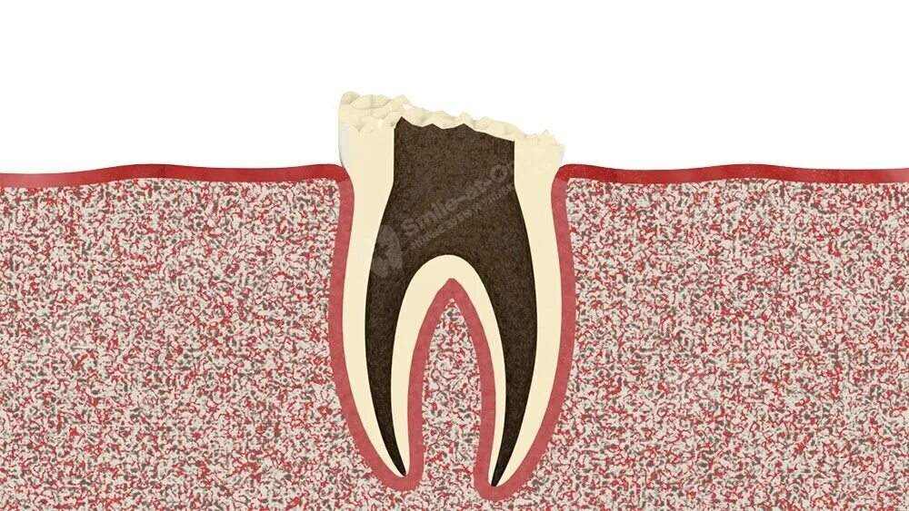 Разрушение зуба более 50 процентов как выглядит Как восстановить зуб, если разрушена коронка, но корень остался? Стоматология Sm