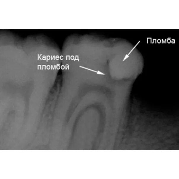 Разрушенный зуб фото Почему возникает вторичный кариес? Отвечает наш стоматолог- терапевт Богрянцева 
