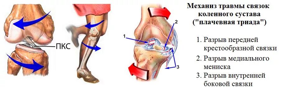 Разрыв мениска коленного сустава симптомы фото Смещение мениска коленного