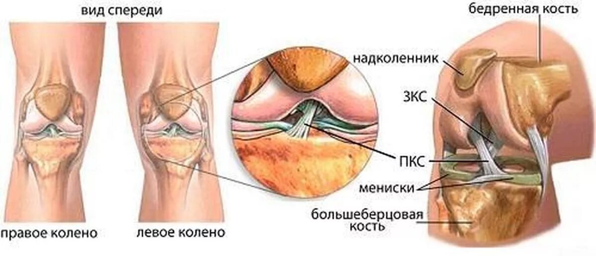 Разрыв мениска коленного сустава симптомы фото Как я повредил колено Пикабу