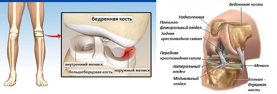 Разрыв мениска коленного сустава симптомы фото Разрыв коленного мениска что делать