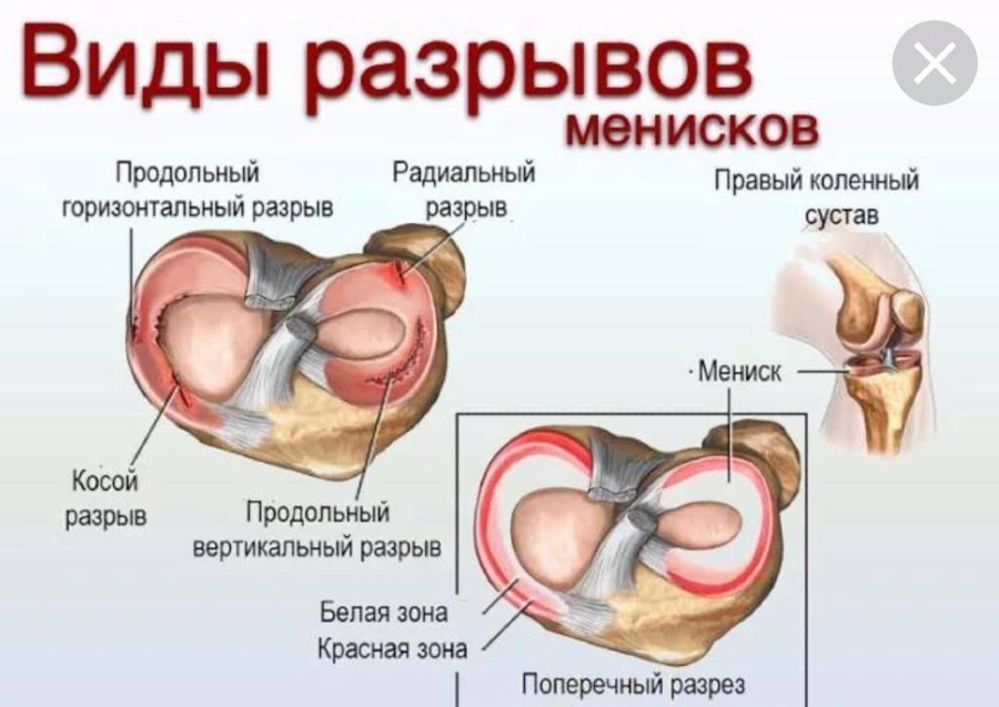 Разрыв мениска коленного сустава симптомы фото Разрыв мениска - симптомы, диагностика, лечение