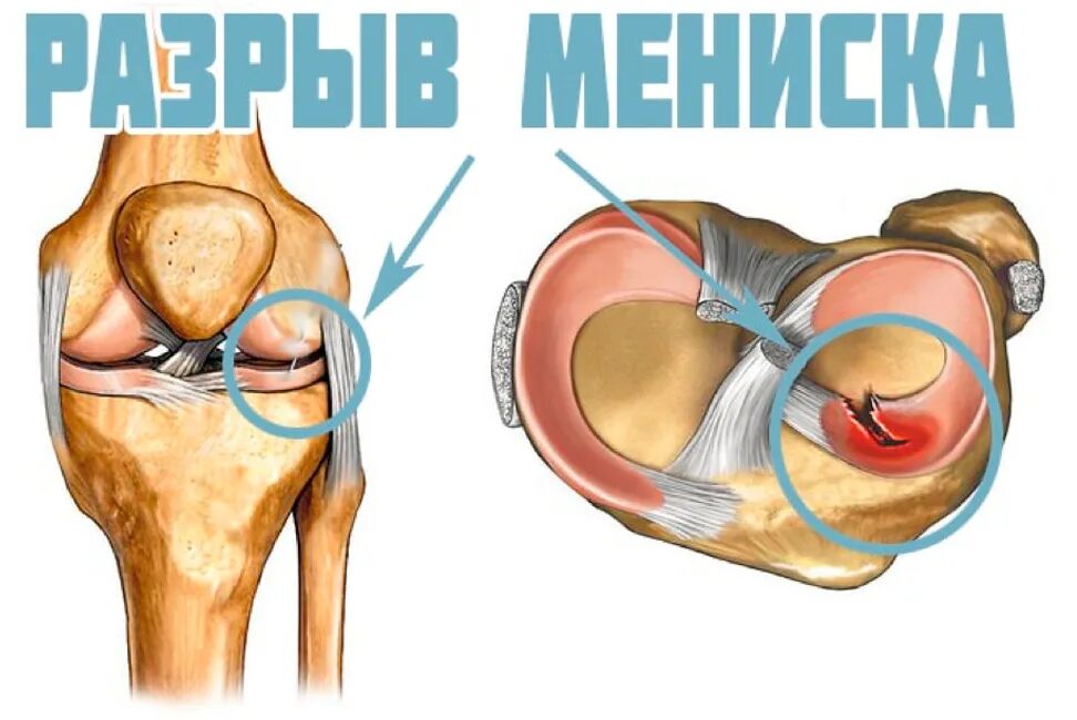 Разрыв мениска коленного сустава симптомы фото Застарелое повреждение связок