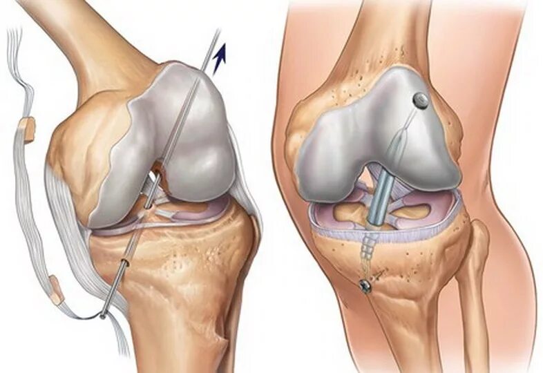 Разрыв мениска симптомы фото Операция на связки коленного сустава