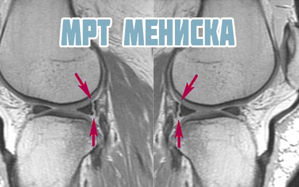 Разрыв мениска симптомы фото Разрыв мениска - симптомы, диагностика, лечение