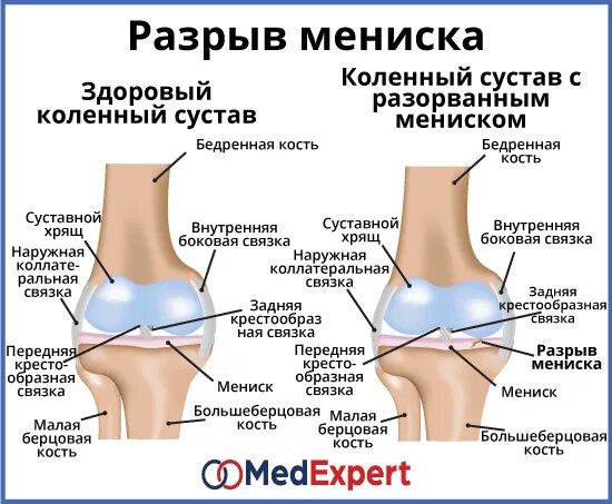 Разрыв мениска симптомы фото Разрыв коленного мениска что делать