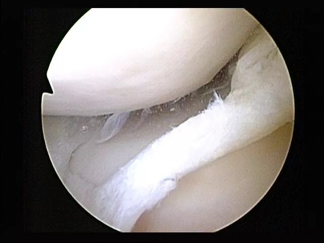 Разрыв мениска симптомы фото File:Tear of medial meniscus.jpg - Wikipedia