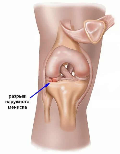 Разрыв мениска симптомы фото Разрыв мениска - Клиника 29