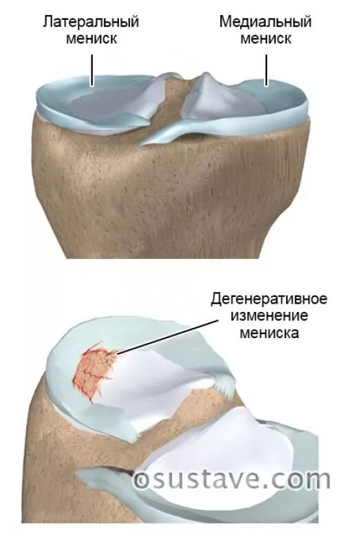 Разрыв мениска симптомы фото Дегенеративное повреждение латерального мениска