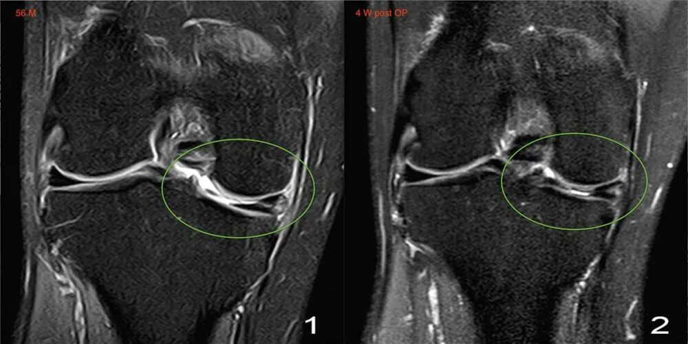 Разрыв мениска симптомы фото Posterior Horn Medial Meniscus Tear - Wirbelsäulen und Gelenke Zentrum München