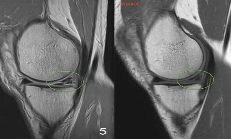 Разрыв мениска симптомы фото Спортивная травма коленного сустава, причины и варианты лечения