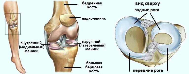 Разрыв мениска симптомы фото Вертикальный разрыв рога мениска