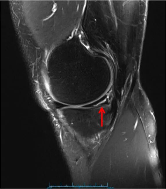 Разрыв мениска симптомы фото Medial Meniscus Tear Knee Specialist Minnesota