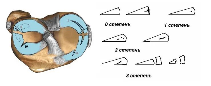 Разрыв мениска симптомы фото Степени повреждения мениска: классификация по Stoller
