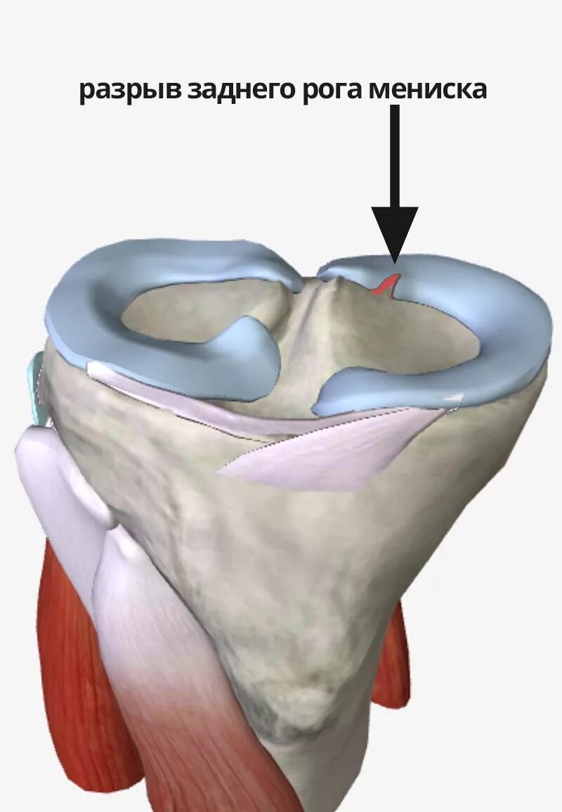 Разрыв мениска симптомы фото Повреждения менисков и лечение