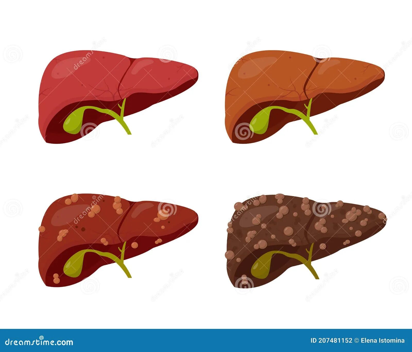 Разрыв печени фото Human Liver Set. Stages of Liver Disease. Stock Illustration - Illustration of c