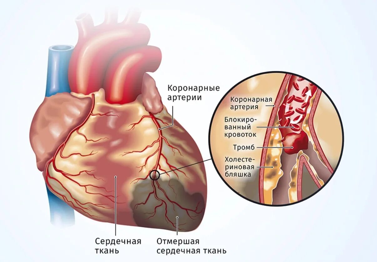 Разрыв сердца фото Лечение ишемической болезни сердца