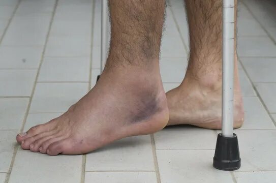 Разрыв связок голеностопного сустава фото симптомы Sprain Ankle Зображення - огляд 12,906 Стокові фото, векторні зображення й відео