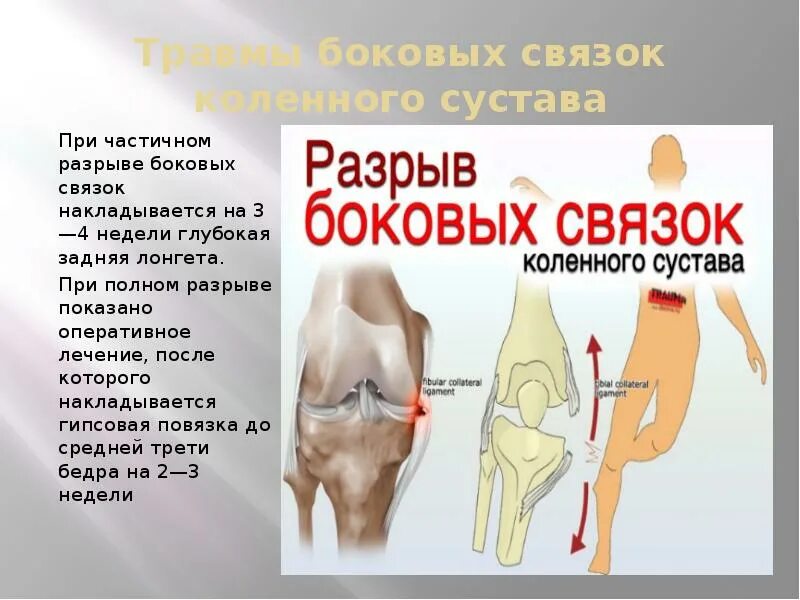 Разрыв связок коленного сустава симптомы фото Схема физической реабилитации при повреждениях коленного