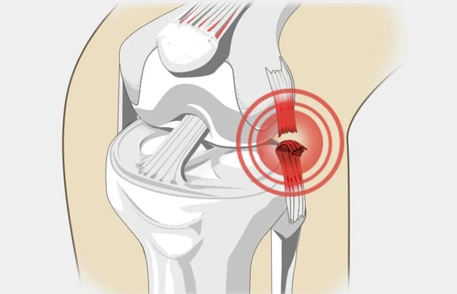 Разрыв связок коленного сустава симптомы фото Разрыв связок - Arimed