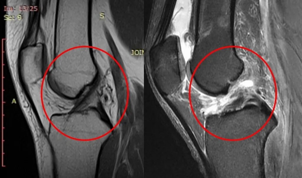 Разрыв связок коленного сустава симптомы фото Пластика передней крестообразной связки (ПКС): операции и лечение в ФНКЦ ФМБА Ро