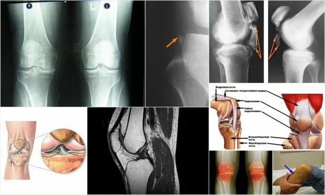 Разрыв связок коленного сустава симптомы фото Дистрофическое изменение крестообразных связок